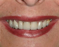 After Cosmetic Dentistry in Annapolis