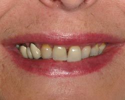 Before Cosmetic Dentistry in Annapolis