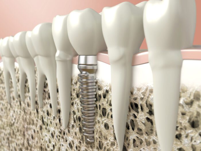 Dental Implants in Annapolis, Maryland
