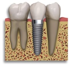 Dental Implant for Missing Teeth