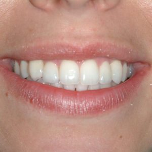 after cosmetic bonding in Annapolis