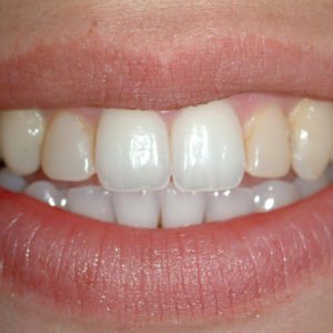 before cosmetic bonding in Annapolis