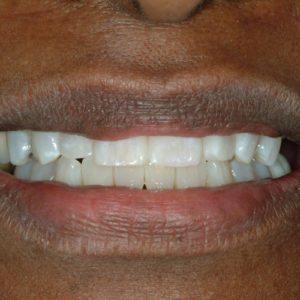 after cosmetic bonding in Annapolis MD