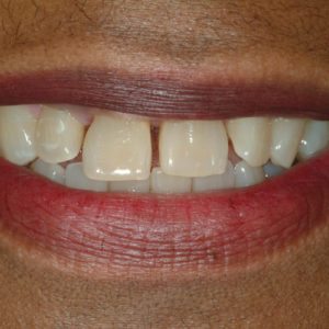 before cosmetic bonding in Annapolis MD