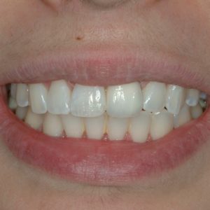 after dental implant in Annapolis Maryland