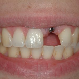 before dental implant in Annapolis Maryland