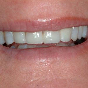 after porcelain veneers in Maryland
