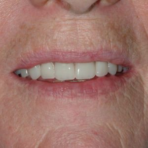 after treatment of implant retained upper denture