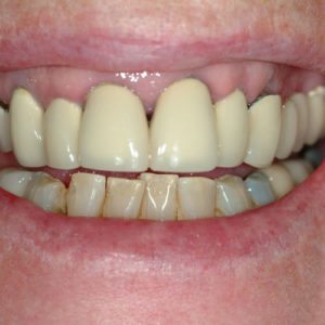 before treatment of implant retained upper denture