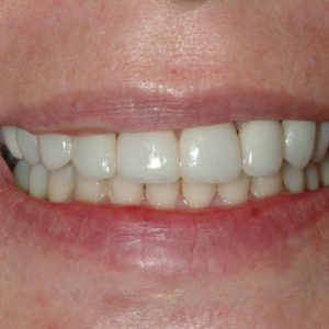 after porcelain veneers and dental crowns