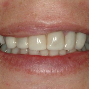 before porcelain veneers and dental crowns