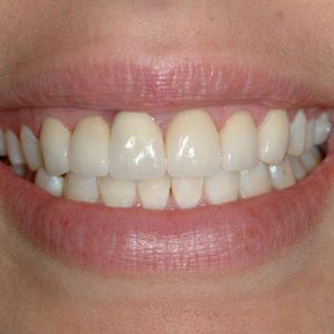 after dental implant replacement