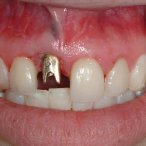 before dental implant replacement