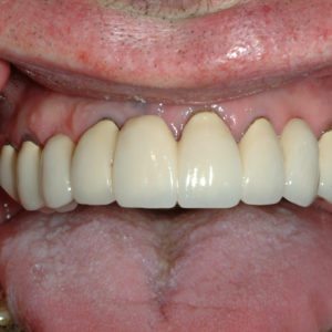 before implant retained fixed upper denture