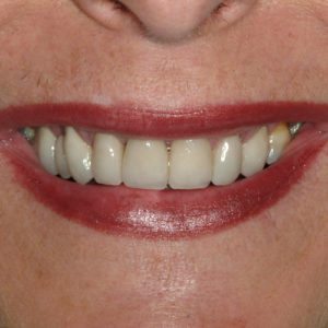 after porcelain veneers in Annapolis