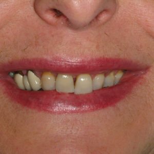 before porcelain veneers in Annapolis