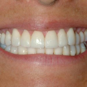 after porcelain veneers in Annapolis