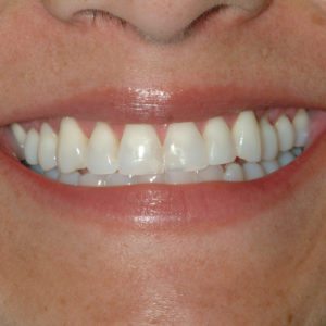 before porcelain veneers in Annapolis