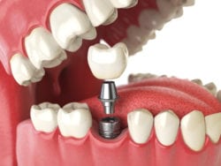 Dental Implants in Annapolis MD Can Restore Your Confidence