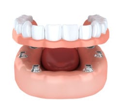 Implant-Secured Dentures in Annapolis MD