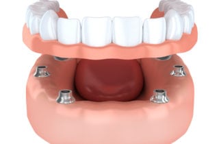 Implant-Secured Dentures in Annapolis MD