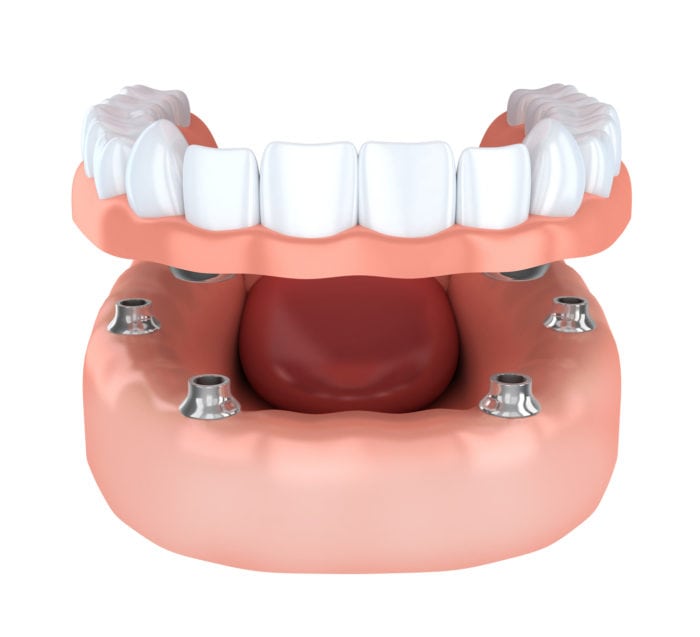 implant-supported dentures in Annapolis