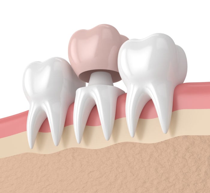 Dental crowns in Annapolis Maryland