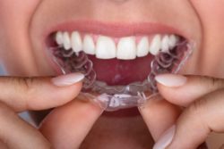 Invisalign in Annapolis MD