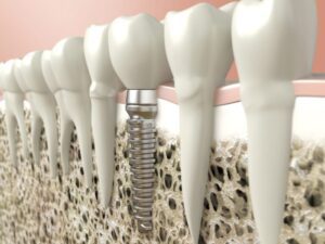 Dental Implants in Annapolis, MD