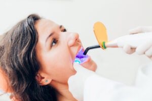 dental fillings in Annapolis, md