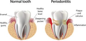 Periodontal Therapy Annapolis, MD