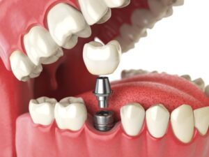 Dental Implant procedure in Annapolis, MD