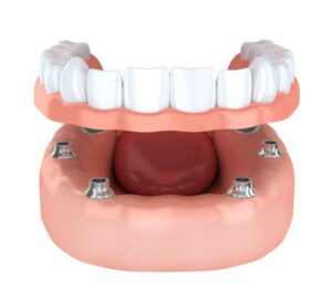 Dentures and Partials in Annapolis, MD