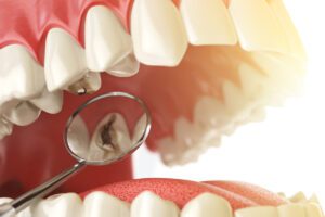 Cavities and Fillings in Annapolis, MD