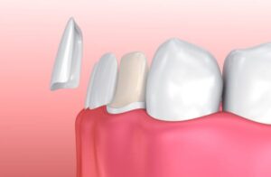 Steps in the process for porcelain veneers in Annapolis, MD