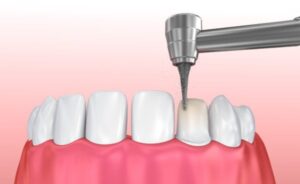 Steps in the process for porcelain veneers in Annapolis, MD