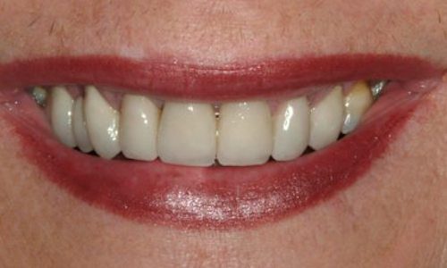 After dental services at Annapolis Center For Dental Health & Wellness