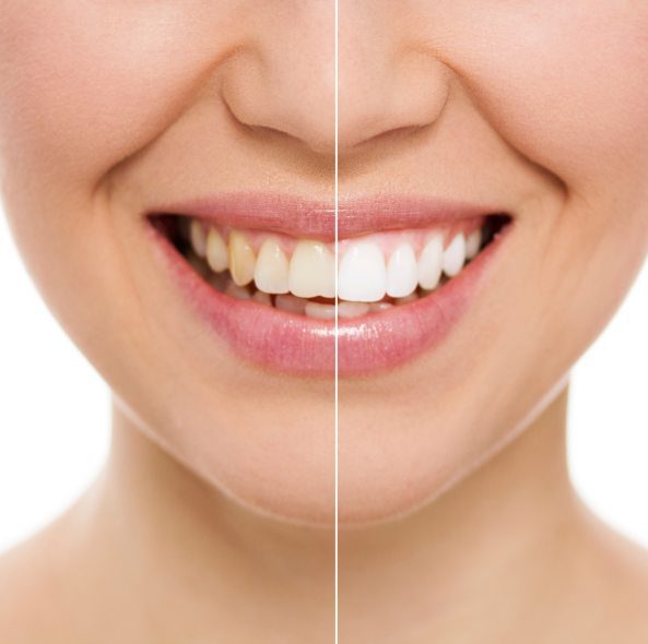 Teeth Whitening cosmetic dentistry in Annapolis, MD