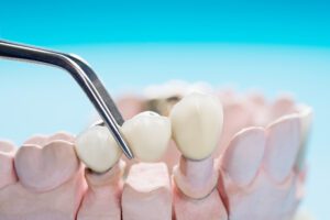 Dental Bridge FAQs
