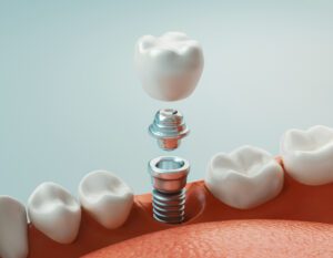 Q&A dental implants in Annapolis, MD