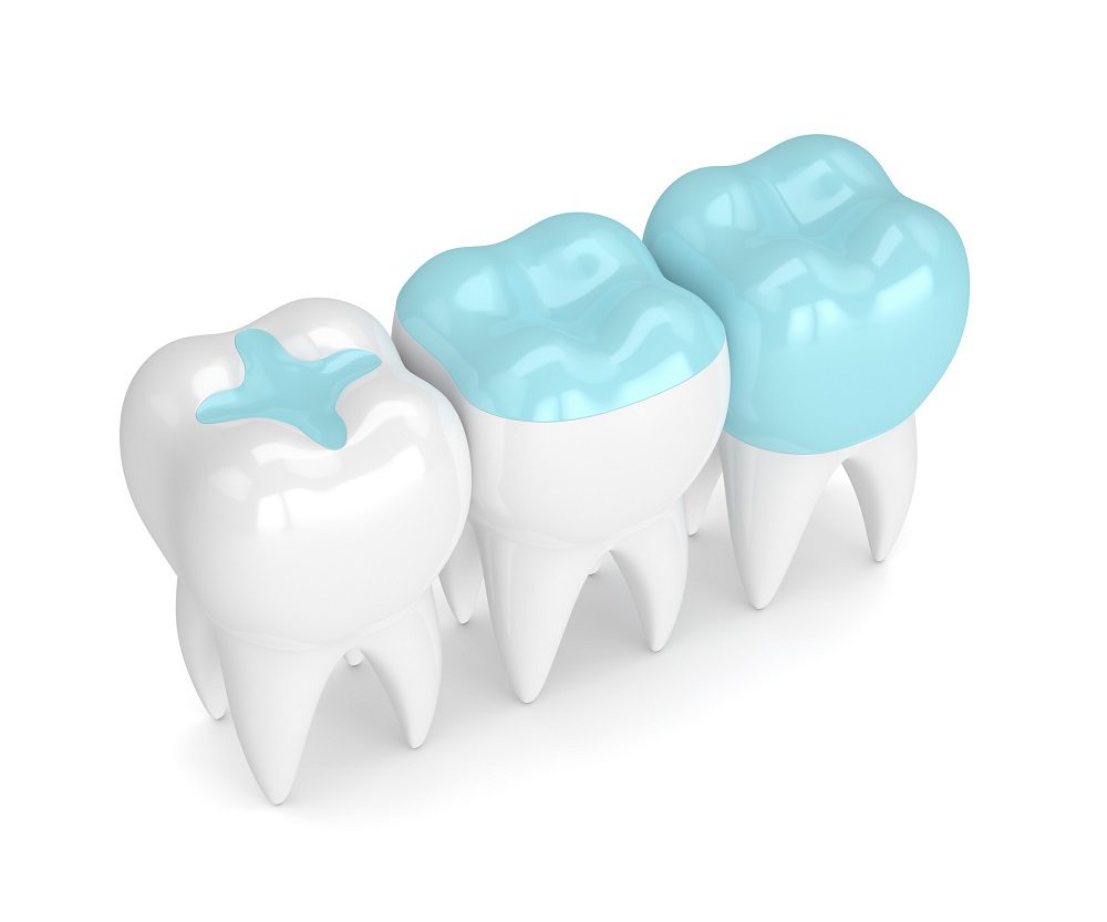 INLAYS and ONLAYS in Annapolis, MD can better protect your teeth after decay