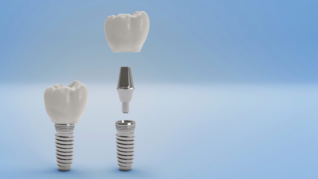 Cost of Dental Implants Annapolis