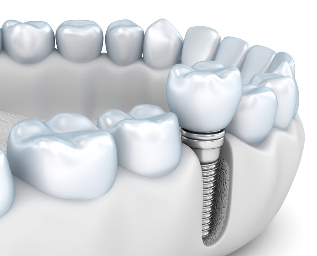 DENTAL IMPLANTS in ANNAPOLIS, MD, can help restore missing teeth