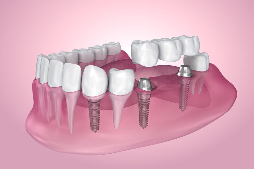 DENTAL BRIDGES in ANNAPOLIS MD can help restore your bite after losing a tooth