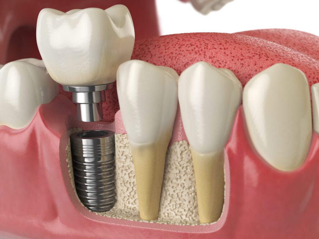 Single Dental Implant in Annapolis MD