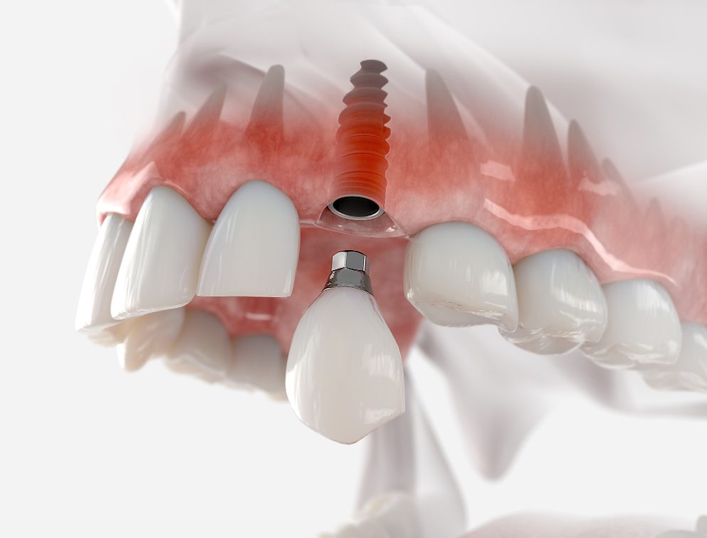 Dental implants could help many patients restore their smile and bite, but they might not be the right option for everyone.