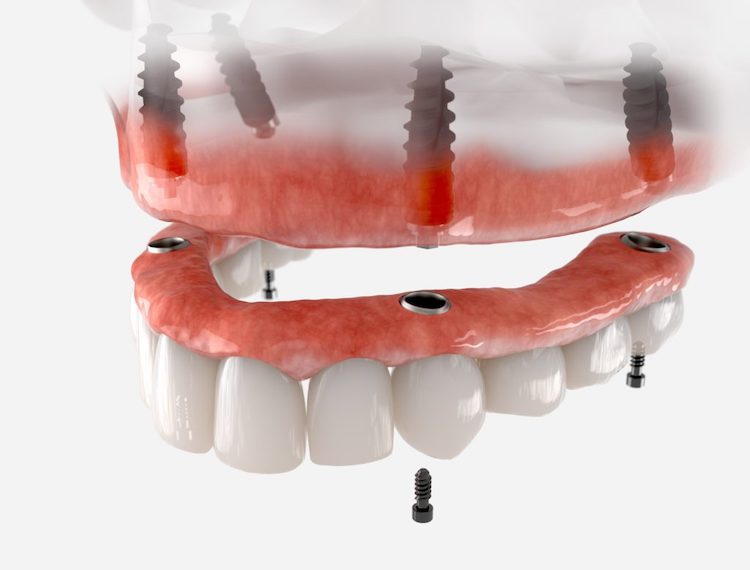 Dental implants often provide a reliable solution for missing teeth. They offer a strong foundation for various dental restorations.