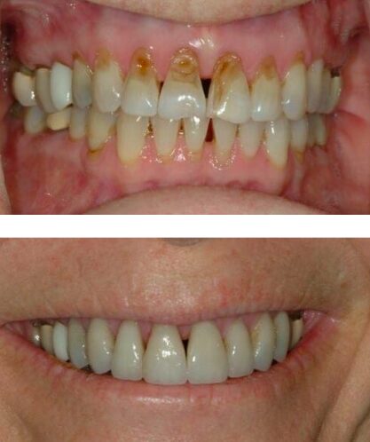 Before and After Dental Veneers