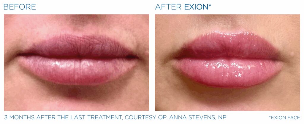 Happy patient before and after facial rejuvenation