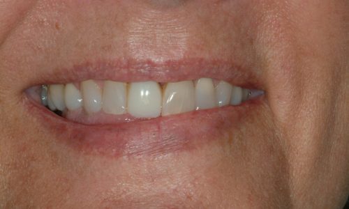 Before dental services at Annapolis Center For Dental Health & Wellness